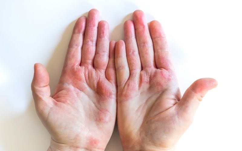 Photo of 2 hands with reddening of skin.